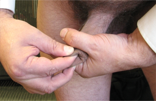 Squeeze-stretch manual tugging method for restoring foreskin Squeeze-stretch manual tugging method for restoring foreskin